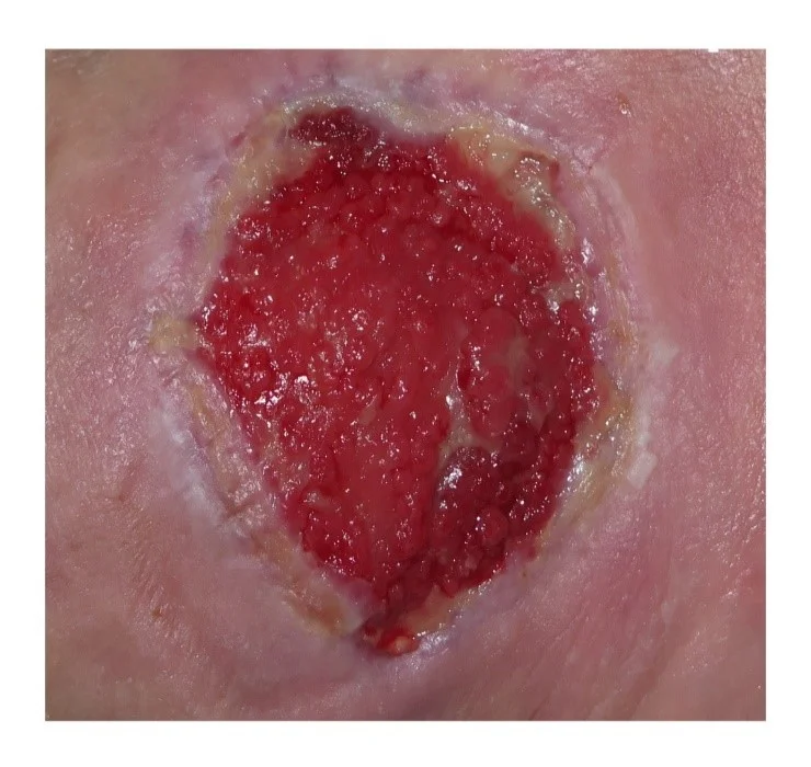 a close-up of a wound