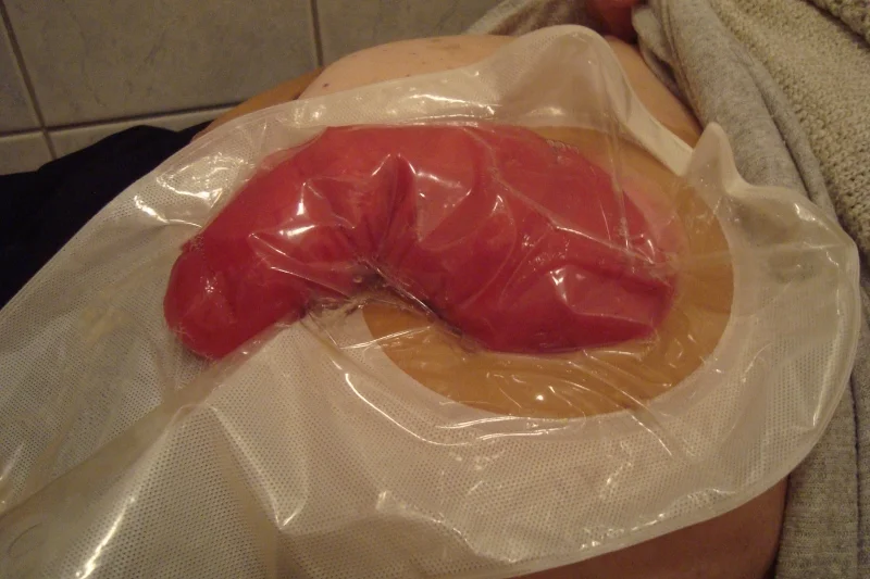 Stomia wypadająca zaopatrzona sprzętem jednoczęściowym