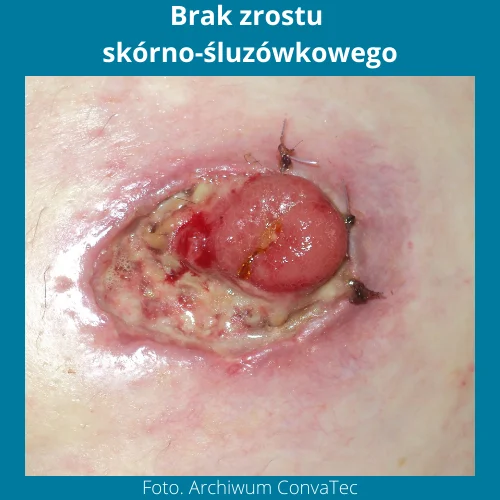 Stomia zdjęcia - brak zrostu sk&oacute;rno-śluz&oacute;wkowego