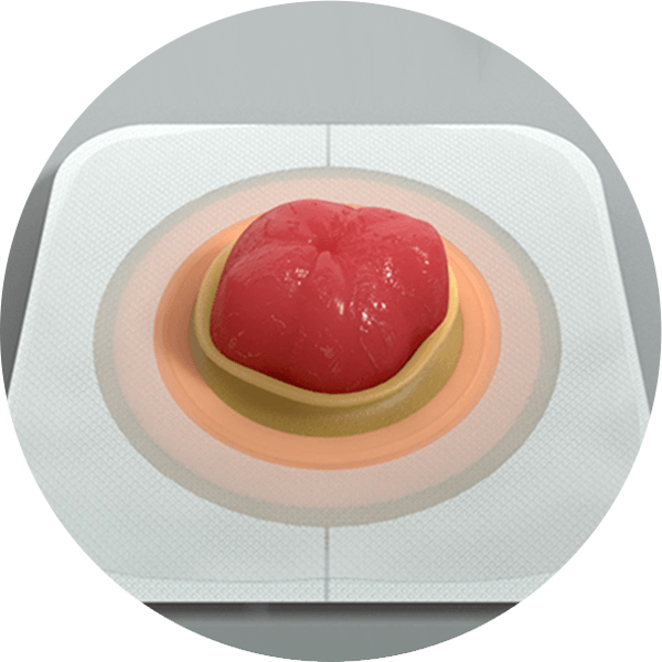 umiestnenie tvarovateľnej podložky na stómiu 